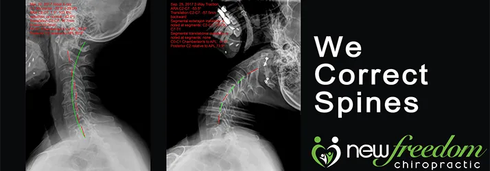 Chiropractic Orléans ON New Freedom Chiropractic Spinal Correction Chiropractic Orléans ON New Freedom Chiropractic Spinal Correction