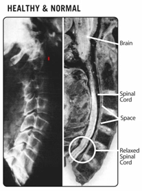 Chiropractic Orléans ON Normal Spine
