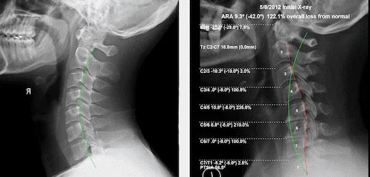 Chiropractic Orléans ON PostureRay Digital Analysis