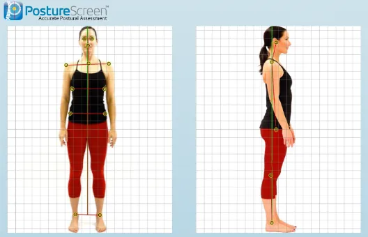 Chiropractic Orléans ON PostureScreen Digital Analysis