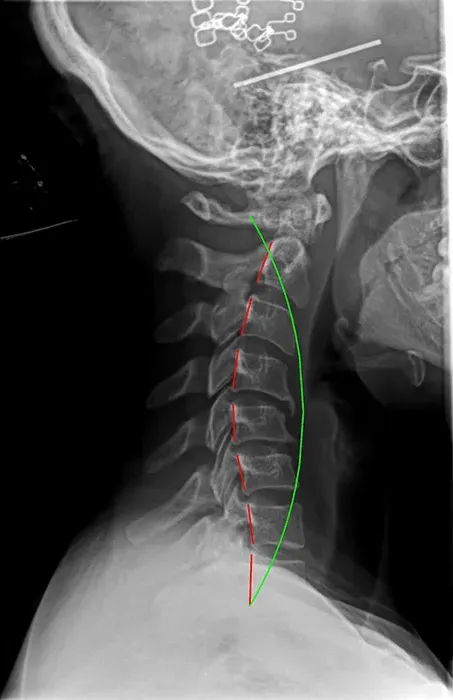 Chiropractic Orléans ON Reversed Cervical Spine