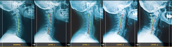 Chiropractic Orléans ON Spine Phases