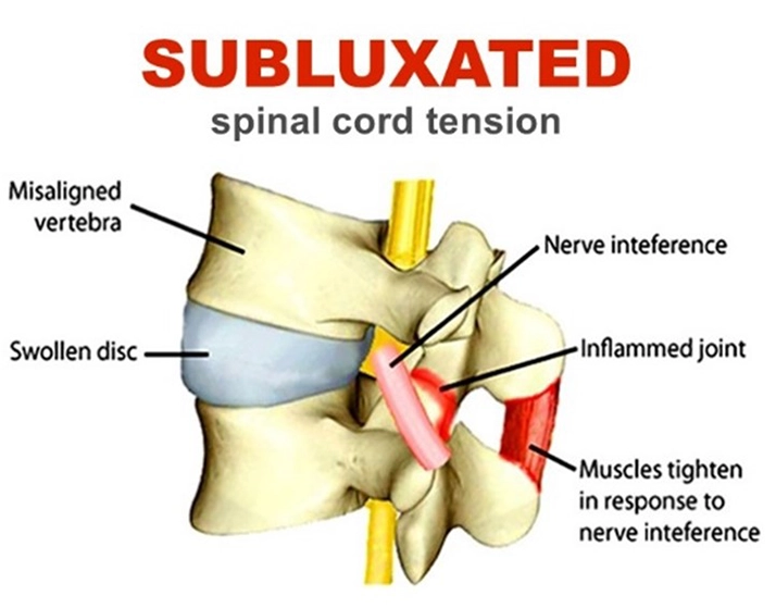 Chiropractic Orléans ON Subluxated Spine