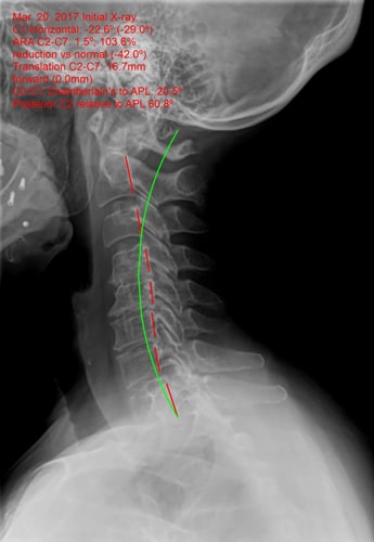 Chiropractic Orléans ON Upper Cervical After X-Ray