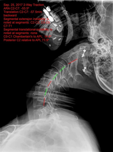 Chiropractic Orléans ON Upper Cervical Before X-Ray