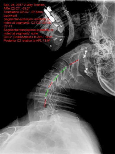 Chiropractic Orléans ON Upper Cervical Before X-Ray Chiropractic Orléans ON Upper Cervical Before X-Ray
